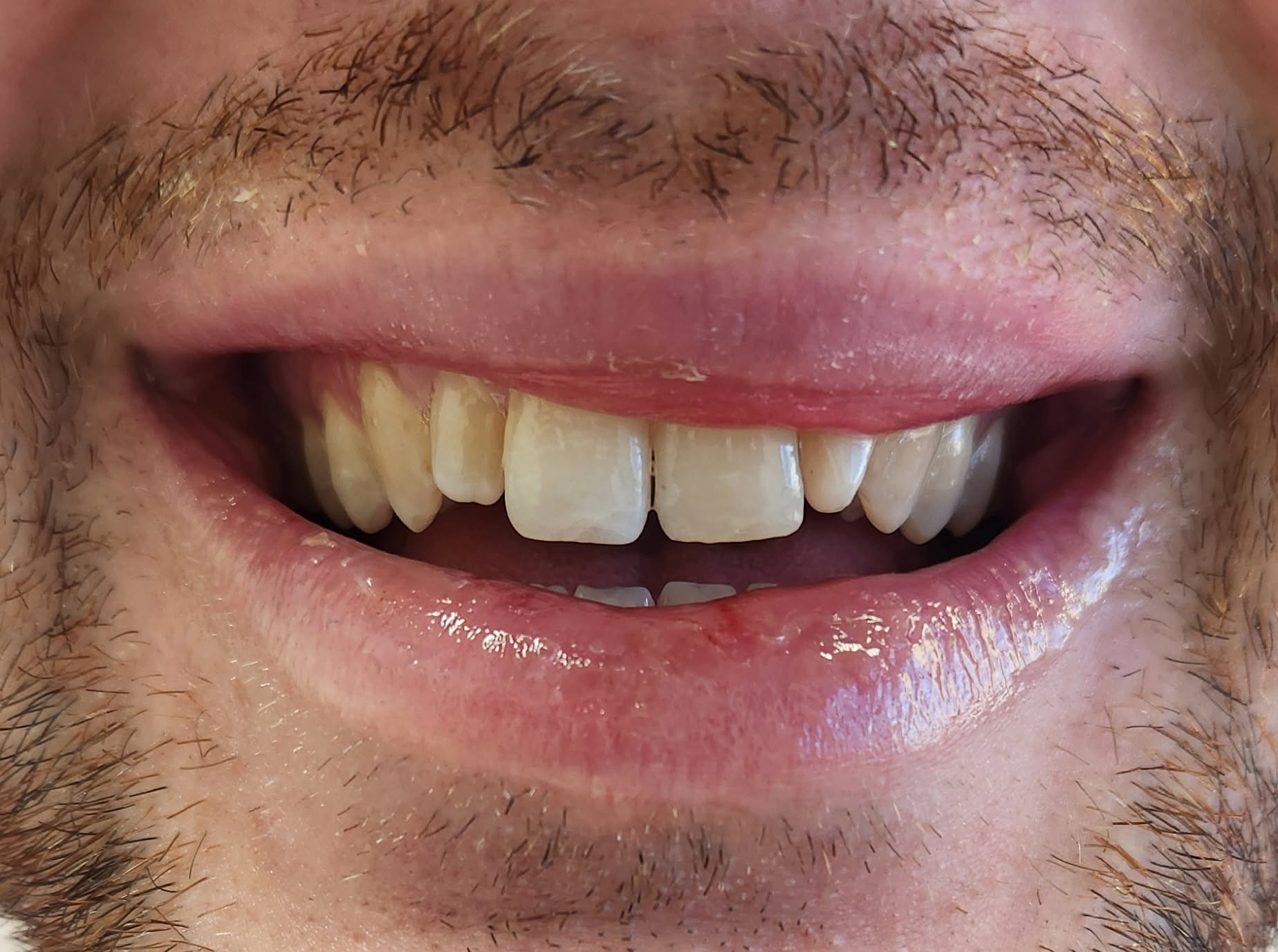 Chipped front tooth fully restored after emergency treatment