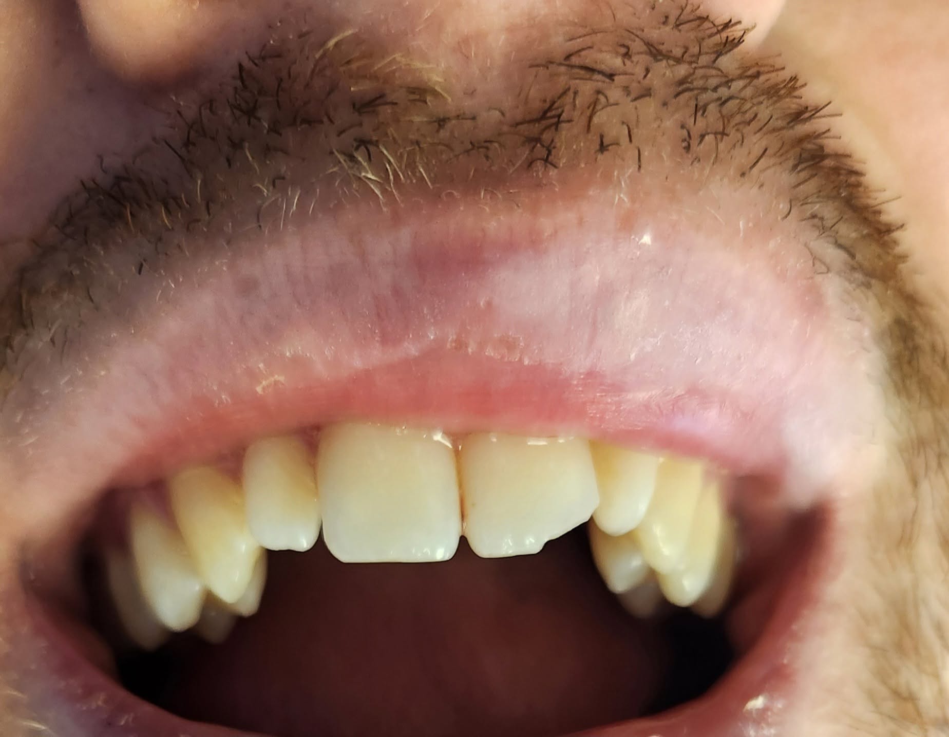 Chipped front tooth trauma before emergency repair