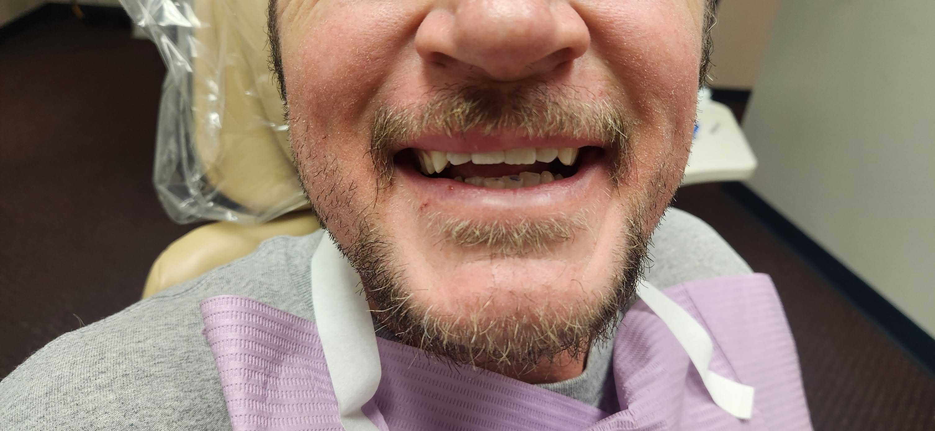 Broken front tooth restored seamlessly
