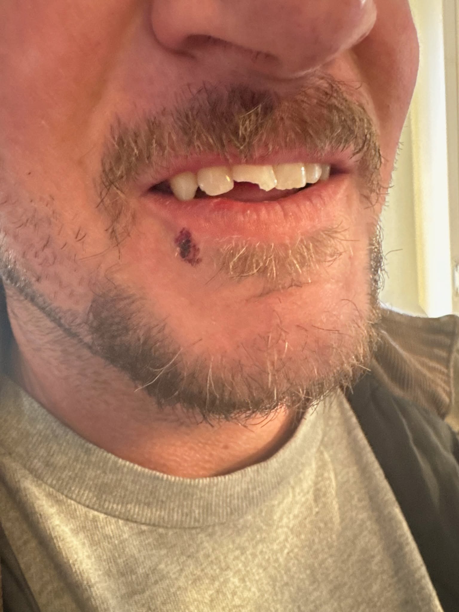 Broken front tooth trauma before repair